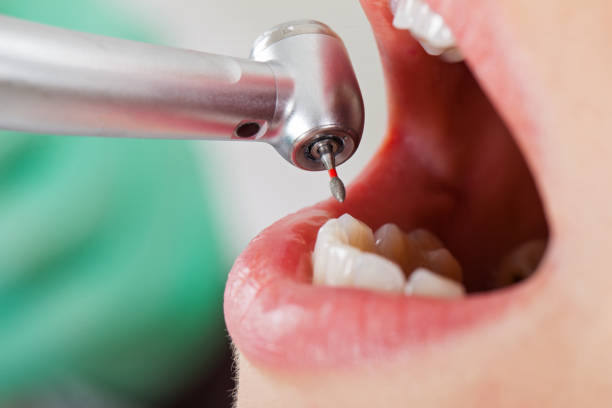 Best Emergency Wisdom Tooth Extraction in Arcade, GA